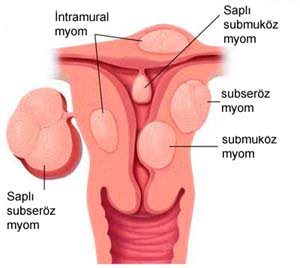 fibroids2