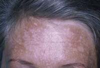 melasma