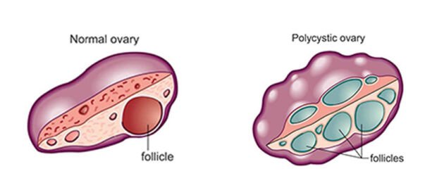 Polikistik over sendromu belirtileri